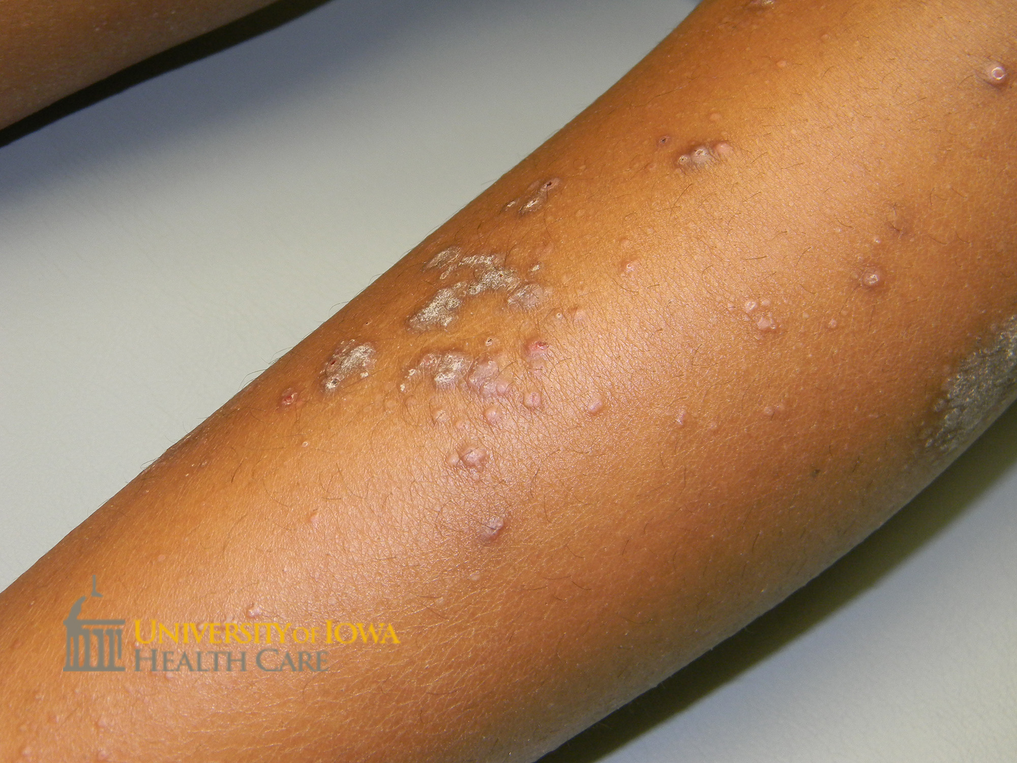 Pink to violaceous polygonal papules with overlying white scale